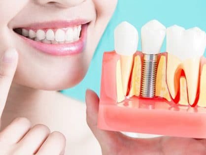 Implantes Dentários​